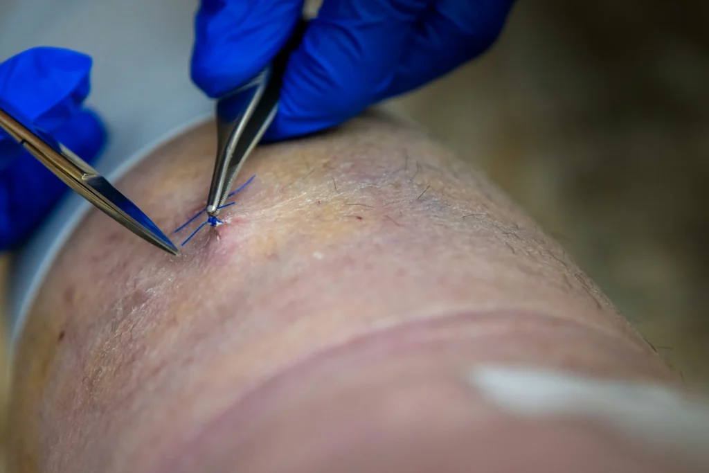 Chronic Wound Care Florida